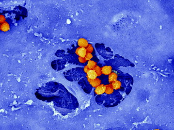 Predicting mortality from S. aureus bacteraemia.
